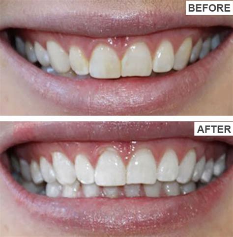 Teeth Whitening Before And After Pictures - Gorgeous Smiles