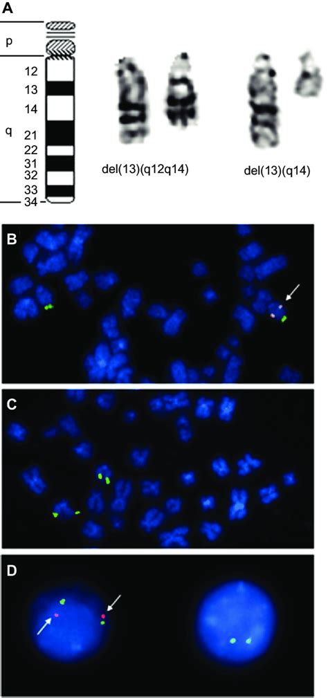 Deletions of chromosome 13 are the most frequent karyotype alterations... | Download Scientific ...