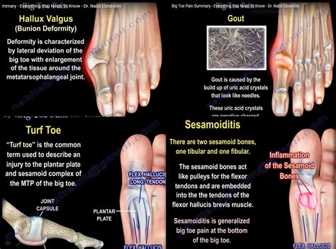 Differential Diagnosis of Big Toe Pain — OrthopaedicPrinciples.com