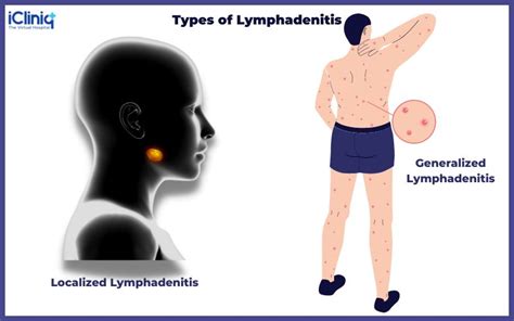 Lymphadenitis - Causes | Symptoms | Types | Risk | Diagnosis | Treatment