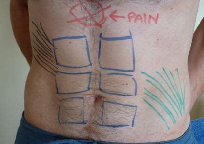 Xiphoid Process Causes Symptoms Treatment Xiphoid Process