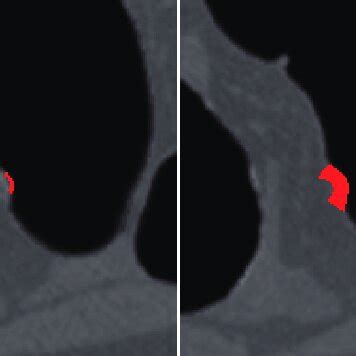 The VOI extraction for a 6 mm sessile polyp in a sigmoid colon. a) The... | Download Scientific ...