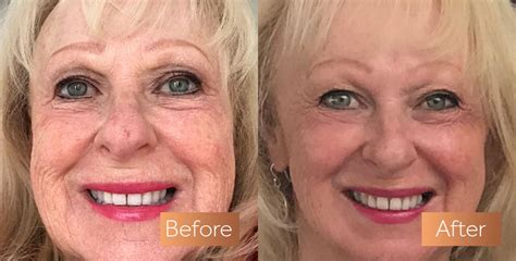 Absolute Collagen Before and After Pictures | Incredible Results – Absolute Collagen Ireland