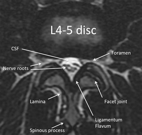 MRI Lumbar Spine Anatomy - Rocky Mountain Brain and Spine Institute