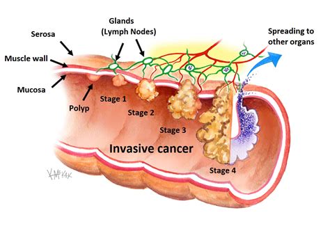 Polyps | Colorectal Surgeons Sydney