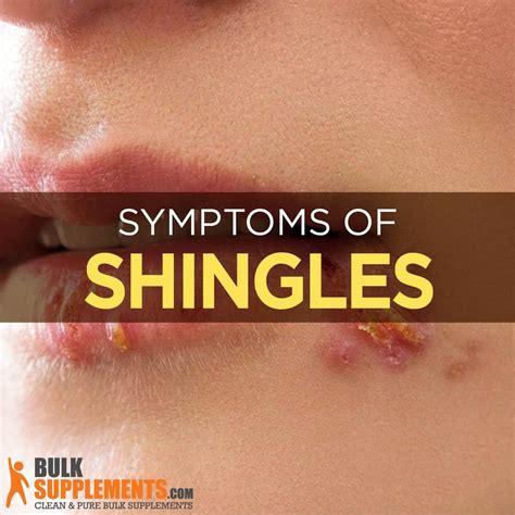 Shingles Symptoms Diagram