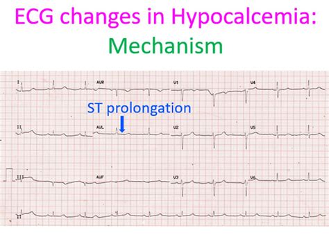 Hypocalcemia Ekg