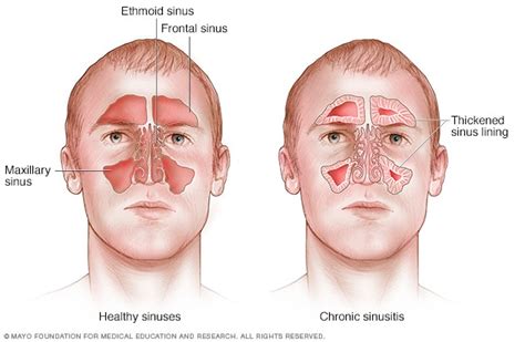 Chronic sinusitis - Symptoms and causes - Mayo Clinic