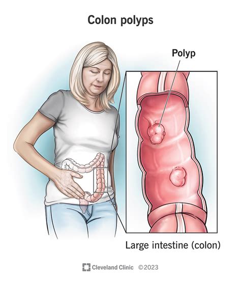 Colon Polyps: Symptoms, Causes, Types & Removal