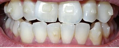 What Are Invisalign Attachments? | Smile Stories