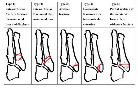 How Are Fifth Metatarsal Fractures Managed By The Virtual Fracture Clinic | CLOOBX HOT GIRL