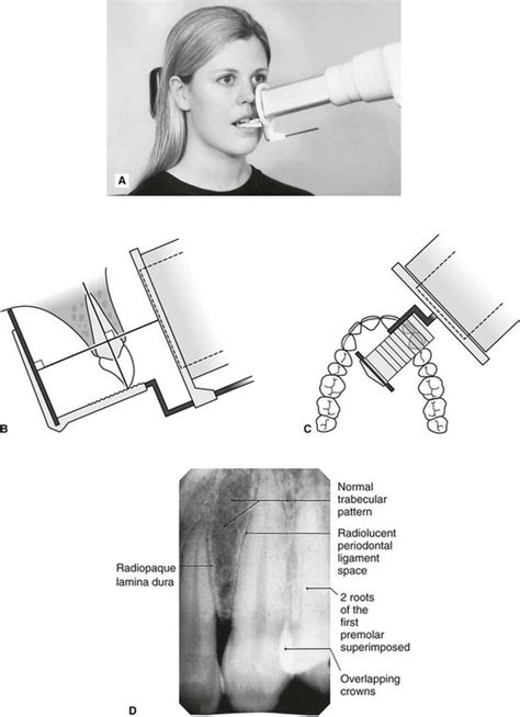 Periapical X Ray