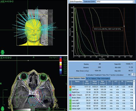 Cavernous sinus/petroclival meningioma – immediate postoperative radiosurgery for residual ...