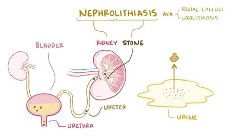 Kidney Stone Diagram