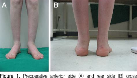 Figure 1 from Treatment of Calcaneovalgus Deformity Following Operative Treatment of Diplegic ...