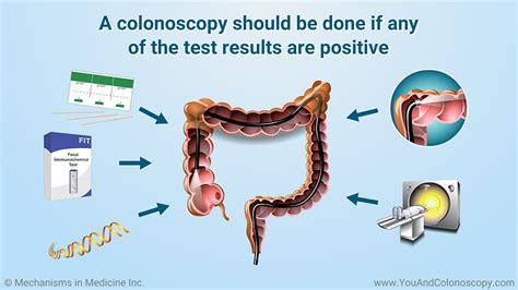 Slide Show - When should I get a colonoscopy and what do the results mean?