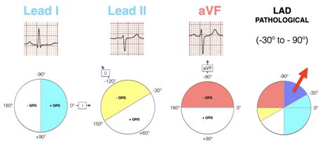 Left Axis Deviation (LAD) • LITFL • ECG Library Diagnosis