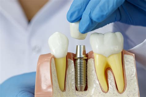 What You Need to Know About Dental Implants - Fairfield Dental Arts