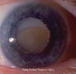 Images For Cataract ~ YOUNG DOCTORS' RESEARCH FORUM