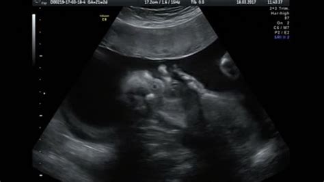 Ultrasound Baby 22 Weeks Part 2 Stock Footage Video (100% Royalty-free) 29607343 | Shutterstock