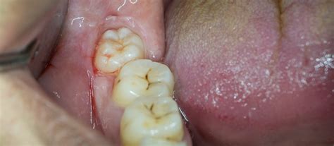 Wisdom Teeth Symptoms - Hermitage Dental Group