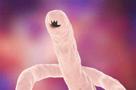 Hookworm infection – causes, side effects and treatments at NaturalPedia.com