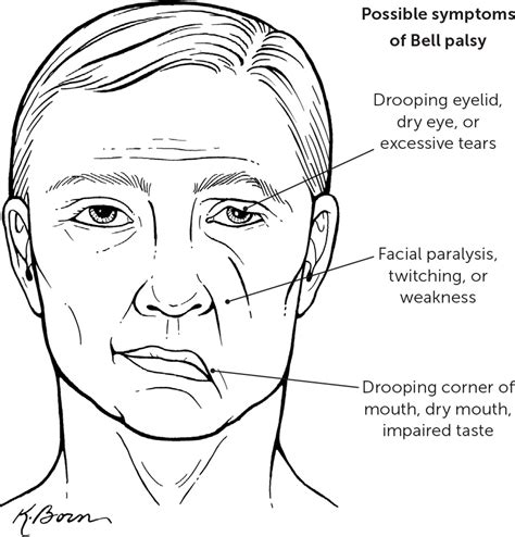 Bell Palsy | AAFP