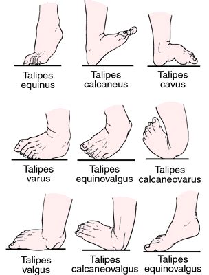 Valgus | definition of valgus by Medical dictionary