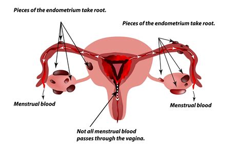 Endometriosis assessment — Women's Ultrasound Specialists Melbourne