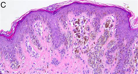 Compound Nevus Histology