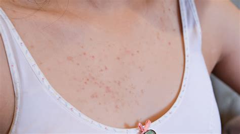 Causes of Chest Acne – How to get rid of it?