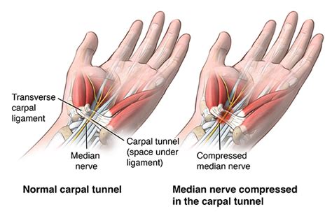 Carpal Tunnel Syndrome | Johns Hopkins Medicine