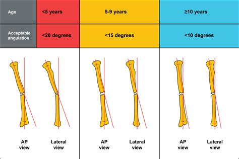 Midshaft radius and ulna fractures | BIPmd