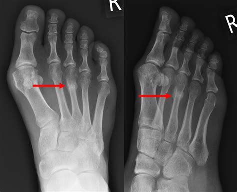 Stress Fracture In Your Foot | Hot Sex Picture