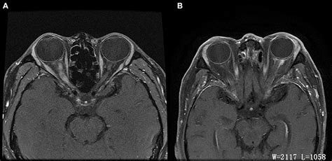 Normal Optic Nerve Mri