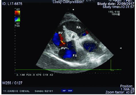 Doppler echocardiogram centred on the pulmonary valve showing pulmonary... | Download Scientific ...