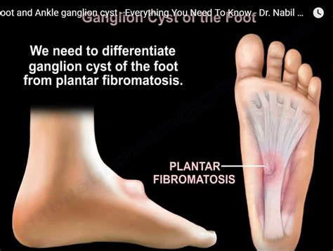 Ganglion Cyst of Foot and Ankle — OrthopaedicPrinciples.com