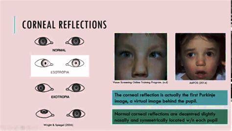 Corneal Light Reflex Abnormal Findings