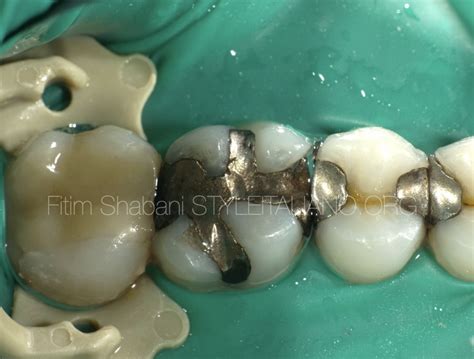 Treatment of a cracked tooth - Style Italiano Endodontics