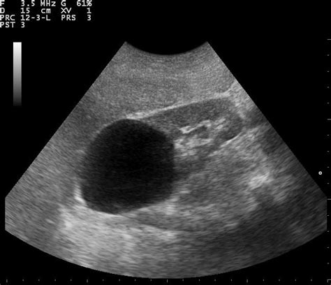 kidney cysts ultrasound