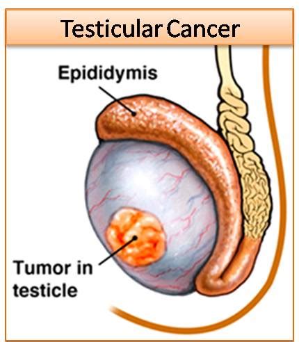 Testicular Cancer: Symptoms, Treatment, Testicular Self Examination