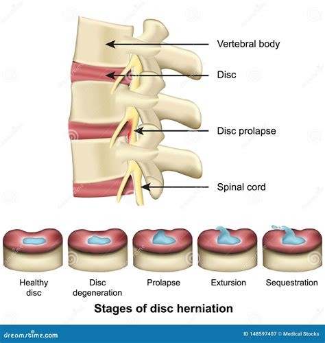 Lumbar Disc Herniation Types