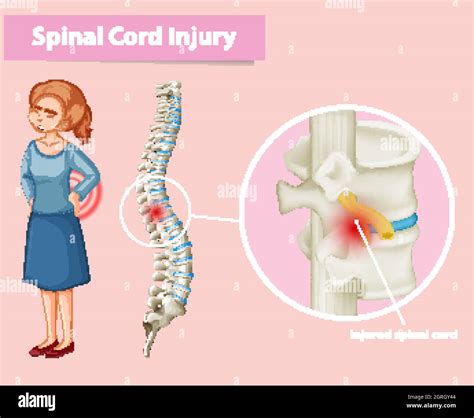 Diagram showing spinal cord injury in human Stock Vector Image & Art - Alamy