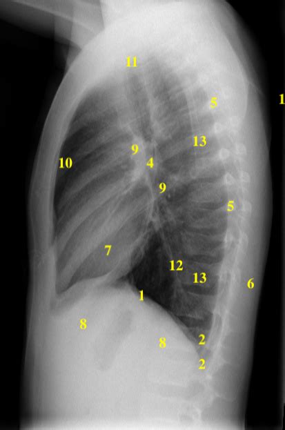 Approach to the Chest X-ray (CXR) – Undergraduate Diagnostic Imaging Fundamentals