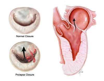 Mitral Valve Leaflets: 7 Important Facts to Know