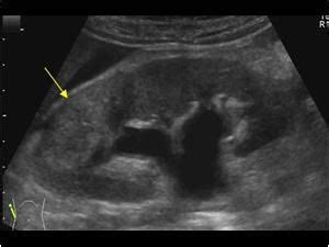 Segmental pyelonephritis | Ultrasound sonography, Diagnostic medical sonography, Medical ultrasound