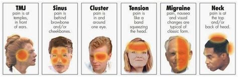 Relieving Headache with DermAureas Bio-electro Stimulation Therapy (DBST) | Mechanism of ...