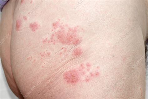 Shingles rash on the buttock - Stock Image - C021/3405 - Science Photo ...