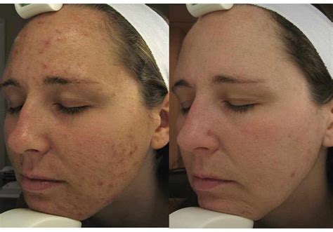 Laser Acne Treatment Expert of East Brunswick, Central New Jersey