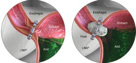 GERD Surgery in Knoxville, TN | Linx Reflux System